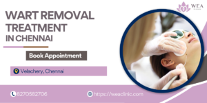 Wart Removal Treatment in Chennai