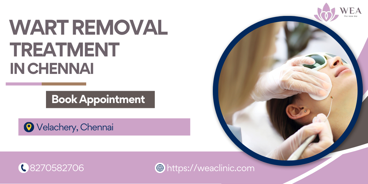 Wart Removal Treatment in Chennai