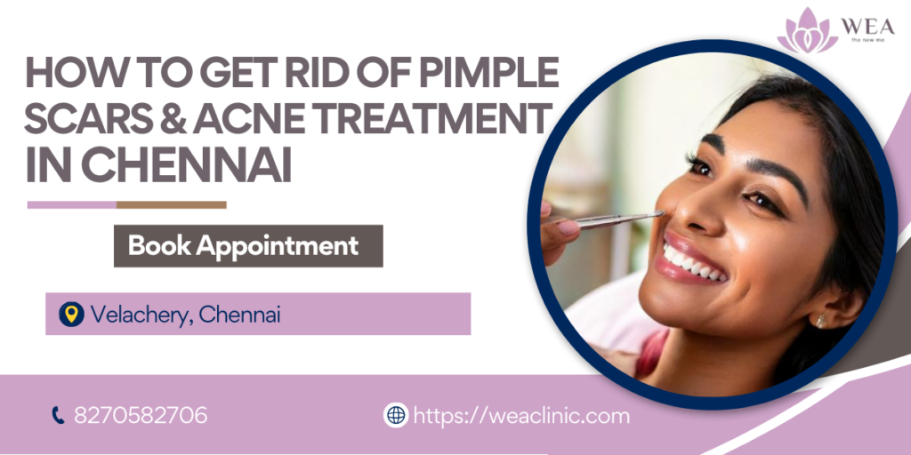 how to get rid of pimple scars and acne treatment in chennai