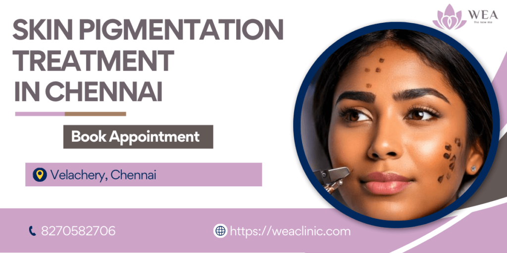 Skin Pigmentation Treatment in Chennai