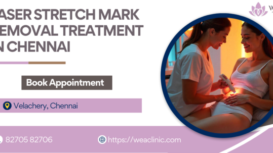 Laser Stretch Marks Removal