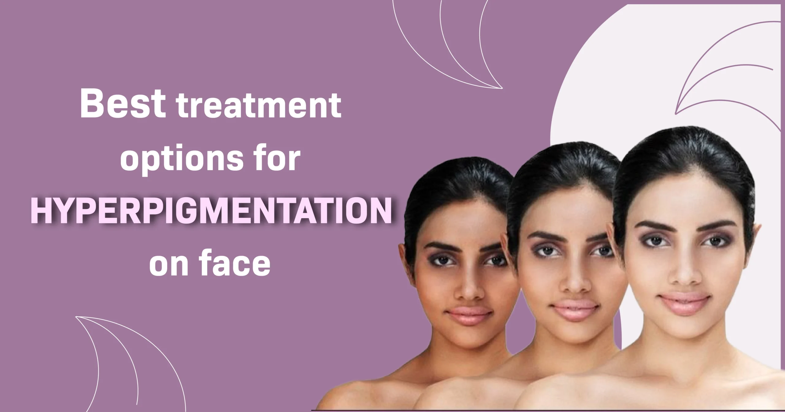 Three women showing improvement in facial hyperpigmentation with text 'Best treatment options for hyperpigmentation on face