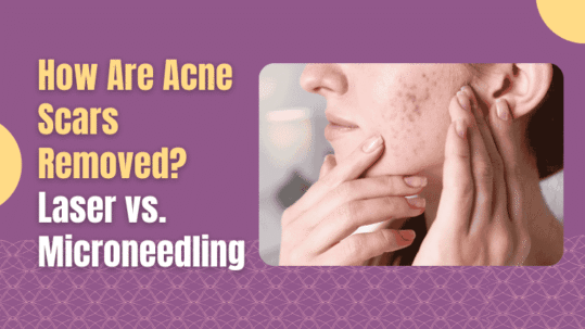 How Are Acne Scars Removed?