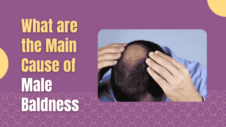 Main Cause of Male Baldness
