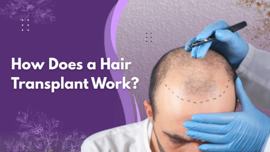 Best Hair Transplant Treatment in Chennai