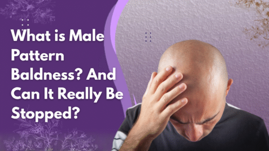 what is male pattern baldness?