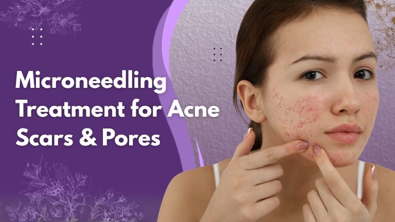 micorneedling treatment for acne and pores