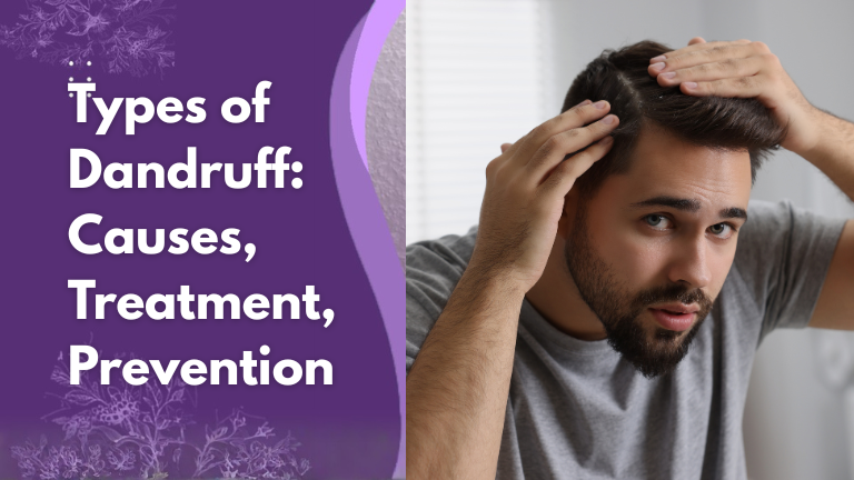 types of dandruff, causes, treatments and prevention