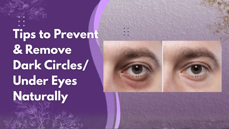 tips to prevent dark circles naturally