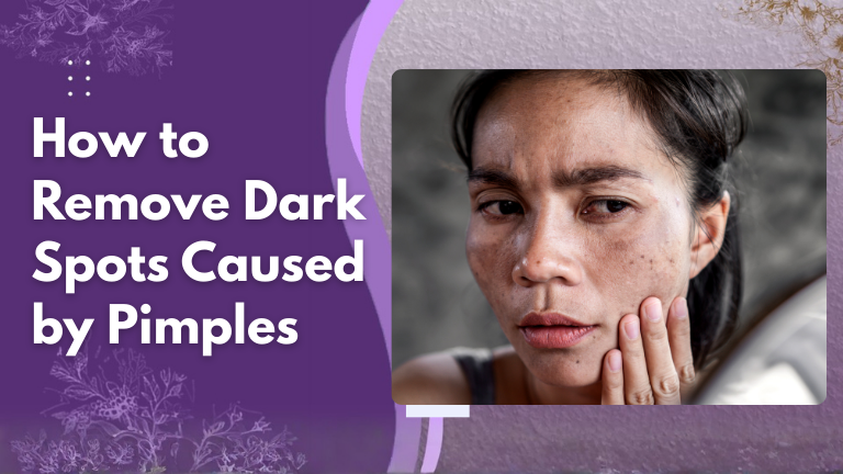 remove dark spots caused by pimples