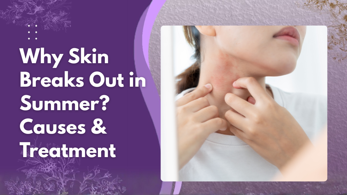 Why Skin Breaks Out in Summer? Causes & Treatment